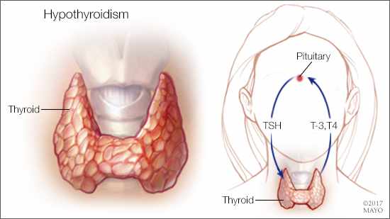 Diet for Hypothyroidism - Dr. Debabrata Sarkar